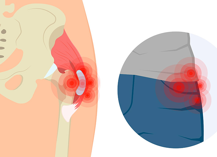 Tendinite du moyen fessier - Chirurgie Orthopedique Valence